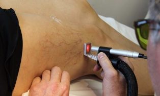 лечение варикоза лазермен